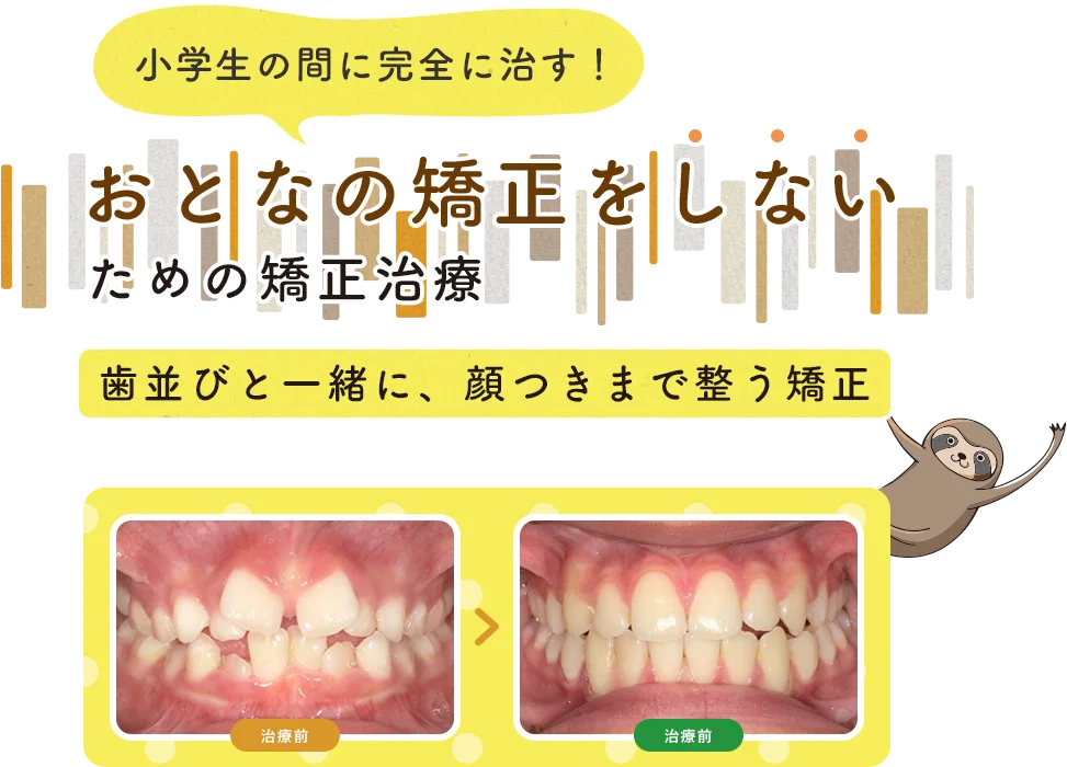 小学生の間に完全に治す！おとなの矯正をしないための矯正治療 歯並びと一緒に、顔つきまで整う矯正